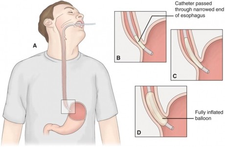 You are currently viewing Homeopathic Treatment of Achalasia Cardia online