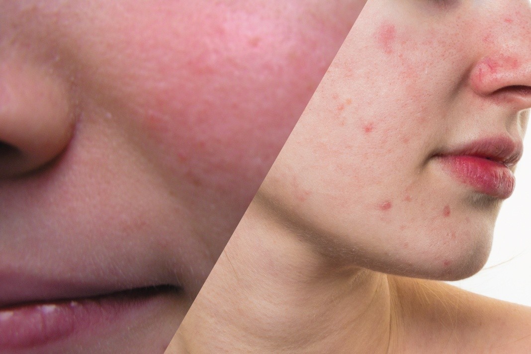 Homeopathic Treatment of acne rosacea online.