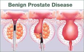 Read more about the article Homeopathy Treatment of Benign Enlargement Of Prostate  Online-Homeopathy Medicine for Benign Enlargement Of Prostate